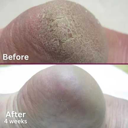 Bye Bye Callus Footlogix Kit – Bild 5